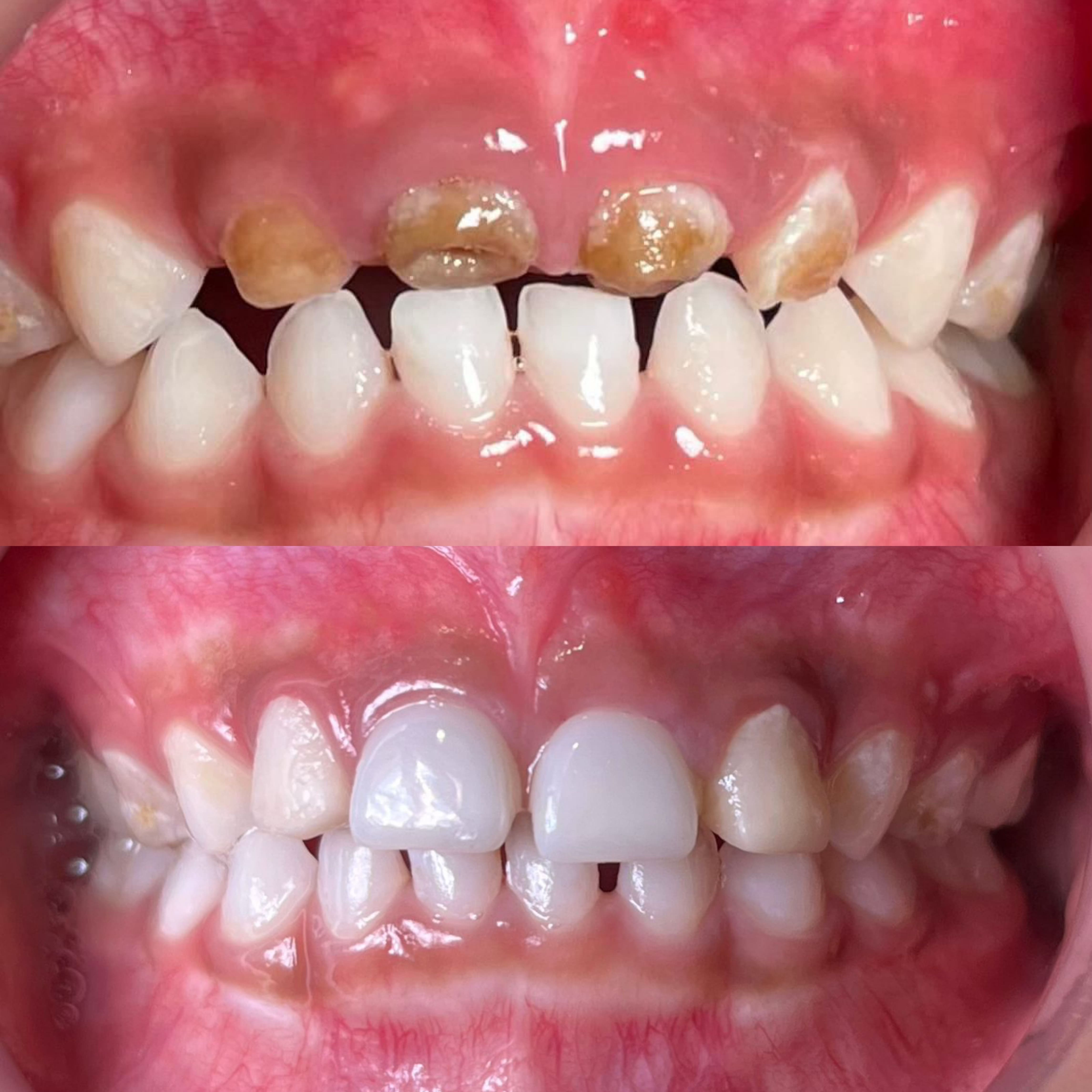 Crown Zirconia Anak