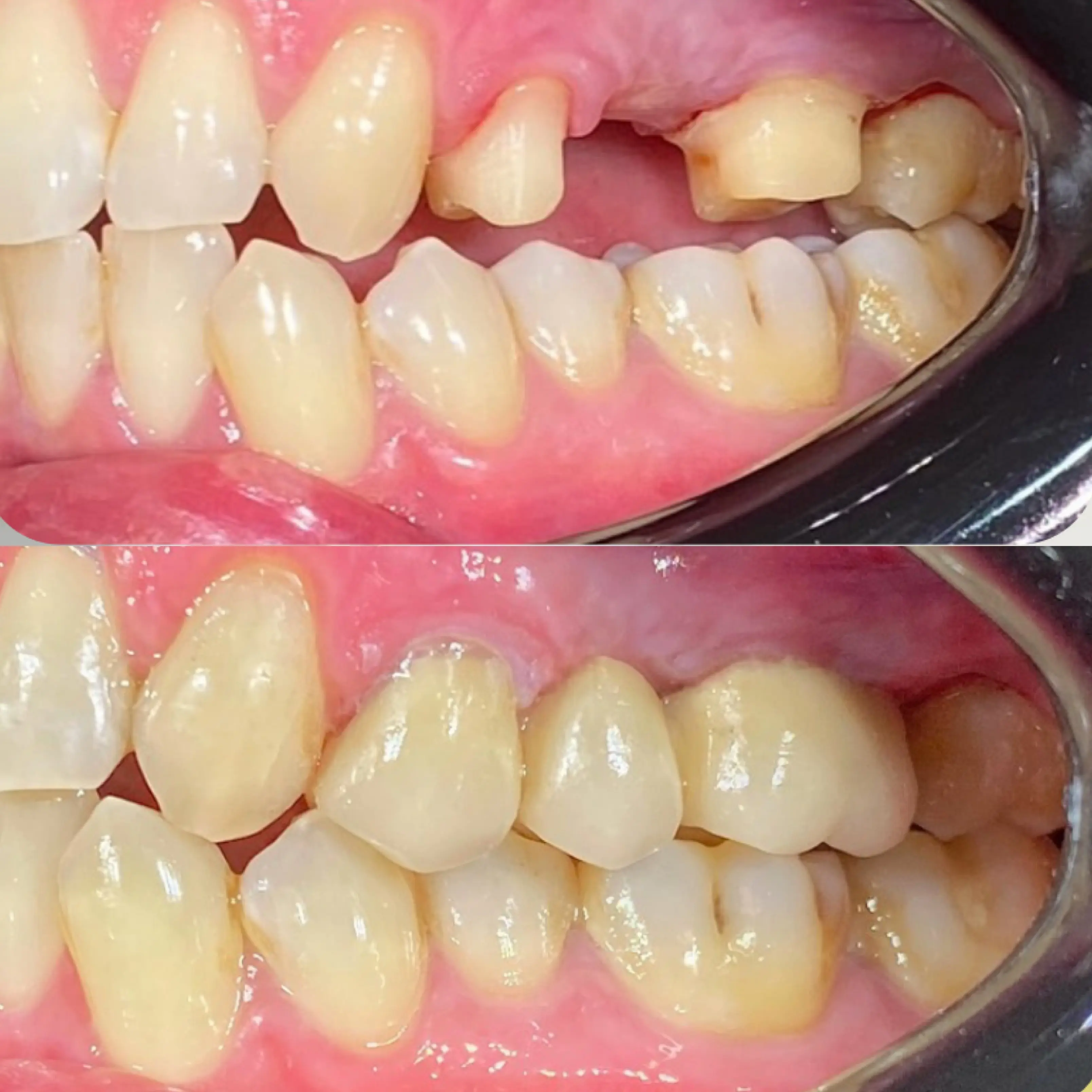Gigi Tiruan Jembatan (Dental Bridge)